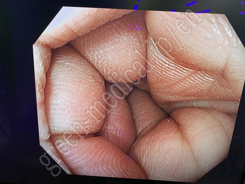 11.○ 大腸ビデオスコープ