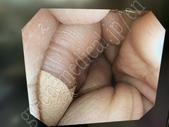 OLYMPUS Video Colonoscope