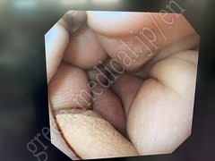 OLYMPUS Video Gastroscope