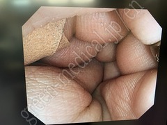 OLYMPUS Video Colonoscope