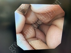 OLYMPUS Video Gastroscope