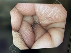 OLYMPUS Video Gastroscope