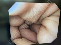 OLYMPUS Video Gastroscope