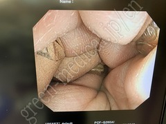 OLYMPUS Video Colonoscope