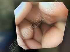 OLYMPUS Video Gastroscope