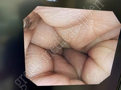 OLYMPUS Video Colonoscope