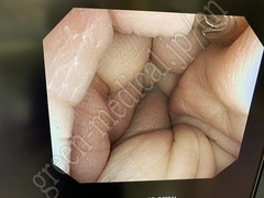 OLYMPUS Video Colonoscope