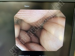 OLYMPUS Video Colonoscope