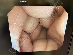 OLYMPUS Video Colonoscope