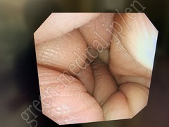 OLYMPUS Video Transnasal Gastroscope