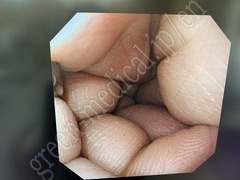 OLYMPUS Video Gastroscope