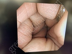 OLYMPUS Video Colonoscope