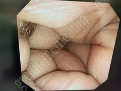 OLYMPUS Video Transnasal Gastroscope