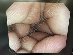 OLYMPUS Video Colonoscope