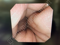 OLYMPUS Video Duodenoscope