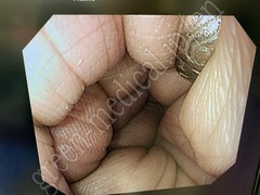 OLYMPUS Gastrointestinal Videoscope