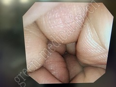 OLYMPUS Video Gastroscope