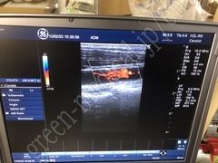 GE Healthcare Intraoperative Linear Probe