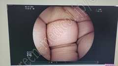 FUJIFILM Double Balloon Enteroscope