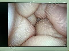 OLYMPUS Video Rhinolaryngoscope (NTSC)