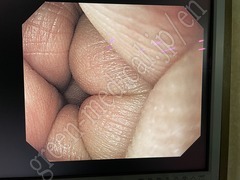 OLYMPUS Video Gastroscope (Parts Condition)