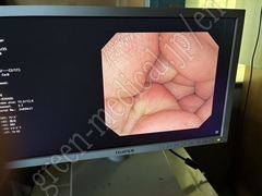 OLYMPUS Video Colonoscope