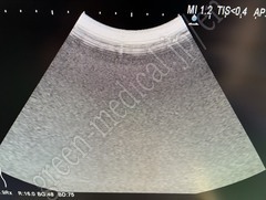 Hitachi Ultrasound Diagnostic System