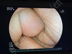 FUJIFILM Video Transnasal Gastroscope