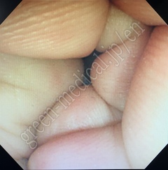 OLYMPUS Video Colonoscope