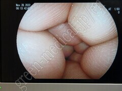 FUJIFILM Double Balloon Endoscope