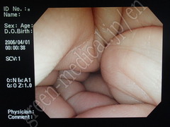 OLYMPUS Video Colonoscope