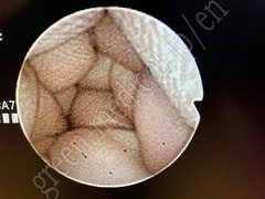 OLYMPUS Rhino Laryngoscope