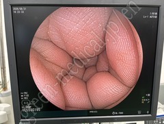 FUJIFILM Video Colonoscope