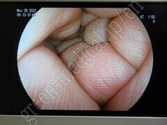 FUJIFILM Double Balloon Endoscope
