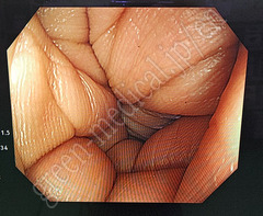 OLYMPUS Video Colonoscope