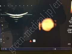 TOSHIBA Ultrasound Color Doppler