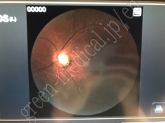TOPCON Fundus Camera