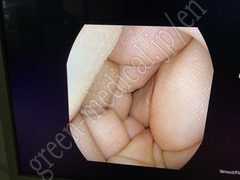 PENTAX Video Gastroscope