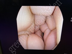 PENTAX Video Colonoscope