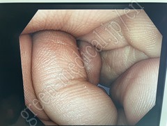 OLYMPUS Video Colonoscope