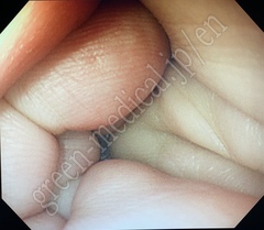 OLYMPUS Video Gastroscope