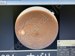 TOPCON Fundus Camera