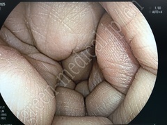 FUJIFILM Video Colonoscope