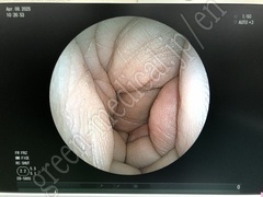 FUJIFILM Video Bronchoscope