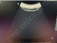 SonoSite Ultrasound Color Doppler