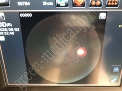 TOPCON Fundus Camera