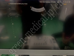 MEDISON Ultrasound Color Doppler