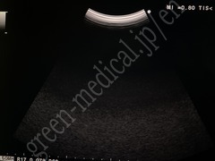Hitachi Color Doppler Ultrasound System