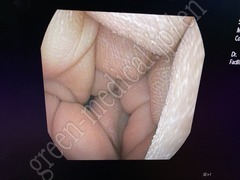 PENTAX Slim Video Gastroscope