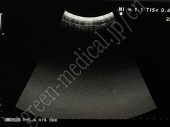 Hitachi Ultrasound Color Doppler